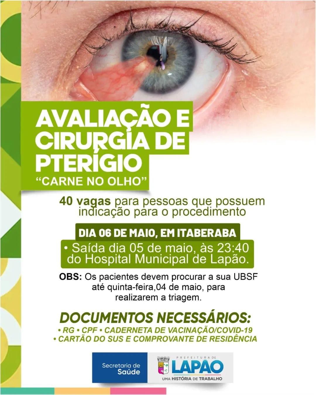 Lapão irá realizar avaliação e cirurgia de Pterígio (Carne no olho)