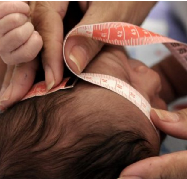 Crianças com síndrome congênita do Zika terão indenização e pensão vitalícia